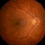 Retina